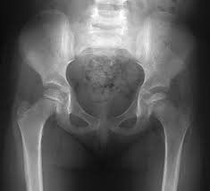 Legg Calve Perthes Disease Pediatrics Orthobullets