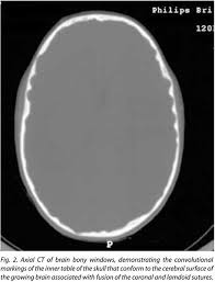 The appearance is called copper beaten skull or brass beaten skull. The Copper Beaten Skull Document Gale Onefile Health And Medicine