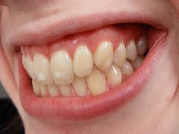 As you may know, tooth enamel is the hardest substance in the body, so how is it possible for it to get stained? Does Tea Stain Your Teeth Facts And Myths Debunked