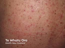 Image result for Generalized Rash