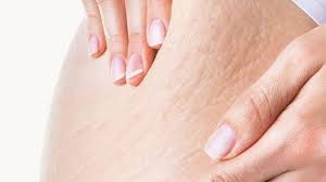 Stretch mark bisa terjadi pada pria maupun wanita, tapi umumnya, kondisi ini sering dialami oleh ibu hamil setelah ia melahirkan. 5 Obat Tradisional Untuk Menghilangkan Stretch Mark Di Kulit Ampuh Dan Minim Efek Samping Tribun Jakarta