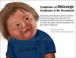 Digeorge Syndrome Symptoms