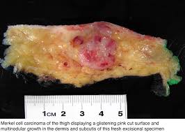Germ cell tumors arise from ectopic pluripotent stem cells that failed to migrate from yolk endoderm to the gonad. Pathology Outlines Merkel Cell Carcinoma