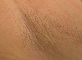 Laser hair removal in st. Laser Hair Removal St Louis Permanent Hair Reduction Missouri