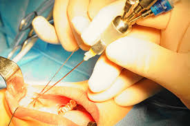 Sialendoscopy is an innovative technique that uses extremely narrow endoscopes to diagnose and treat many conditions of the salivary glands. References In Sialendoscopy Assisted Treatment For Chronic Obstructive Parotitis Related To Sjogren Syndrome Oral Surgery Oral Medicine Oral Pathology And Oral Radiology
