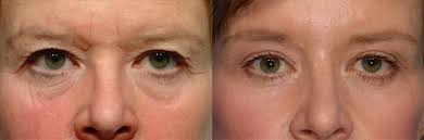 How inexpensive is brow lift overseas. Do I Need A Brow Lift Or Blepharoplasty Pearlman Aesthetic Surgery