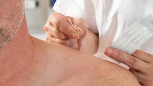 Kuru Igne Tedavisi Hangi Hastaliklara Iyi Geliyor Saglik Haberleri