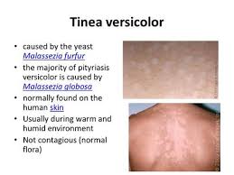 There are several ways a doctor can distinguish between the two disorders: Pityriasis Tinea Versicolor A Chronic Superficial Fungal Disease Of The Skin Characterized By Well Demarcated White Pink Fawn Or Brownish Lesions Ppt Download