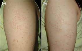 It looks and feels like rough, small bumps. A 18 Year Old Female Patient With Keratosis Pilaris Patient 4 Showed Download Scientific Diagram