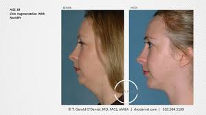Chin Augmentation Louisville