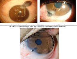 Image result for Eye Foreign Body