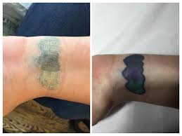 As a service of the renowned new york dermatology group, we are focused on providing the finest in education and customer service to our tattoo removal patients. An Interesting And Maybe A Little Confusing Tattoo Beginning To Clear Up After Just One Session Of Tattoo Re Circle Tattoo Design Circle Tattoo Tattoo Removal