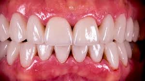 Do you want to know how to close gaps in teeth, or how you can fix the gap in your front teeth? What Are Black Triangles Between Your Teeth