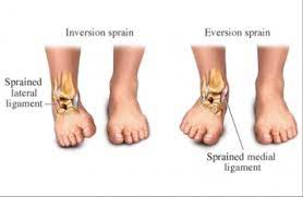 Ankle Sprains Kingsland Physio And Massage
