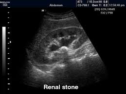Pin By Luisvaldivieso On Abdomen Pelvis In 2020 Renal Renal Calculi Ultrasound