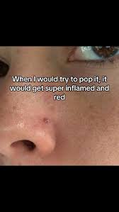 Image result for skin cancer on nose pimple