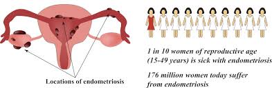 Der verlauf ist nicht vorhersagbar. Mooci Endometriose Schmerzen Wahrend Der Periode