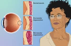 They gave me an injection and it really. Eyesight In The Elderly Physiopedia