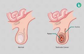 Non seminoma (some doctors may call these teratomas) both types develop from germ cells in the testicles. Testicular Cancer Symptoms Causes Treatment Medicine Prevention Diagnosis