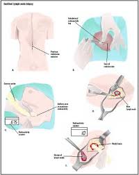 Biopsy definition a biopsy is the removal of tissue or cell samples for the purpose of examination using various biological techniques to gain information regarding the disease status of a particular tissue. Sentinel Lymph Node Biopsy Procedure Tube Removal Complications Cells Cancer Rate Definition