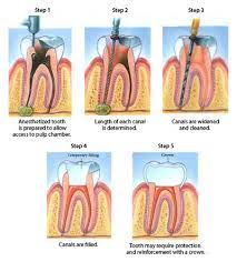 But, did you know that there are several things that could warn root canal treatment is a restorative measure to remove the infection from inside of a tooth's main structure and root canal. Will Root Canal Failure Lead To Extraction And A Dental Implant Bayou Dental Group