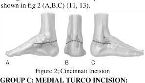 Activity should be limited to quiet play for the first week after leaving the hospital. A Comparative Study To Determine The Effectiveness Of Three Surgical Techniques Used In The Treatment Of Severe Congenital Idiopathic Club Foot Using The Dimiglio Scoring System Semantic Scholar