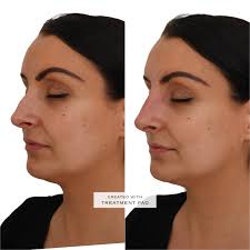 The exciting news that you've all been waiting for. For the month of  February, we have something so exciting planned🤭 This month of love, we  are offering 10% off ALL lip filler