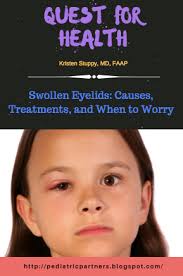 Maybe you would like to learn more about one of these? Quest For Health Swollen Eyelids Causes Treatments And When To Worry