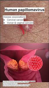 Image result for human papillomavirus symptoms