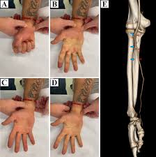 Image result for Allen Test