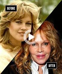 Celebrity Plastic Surgeries Gone Wrong Melanie Griffith In 2020 Plastic Surgery Celebrity Plastic Surgery Plastic Surgery Fail