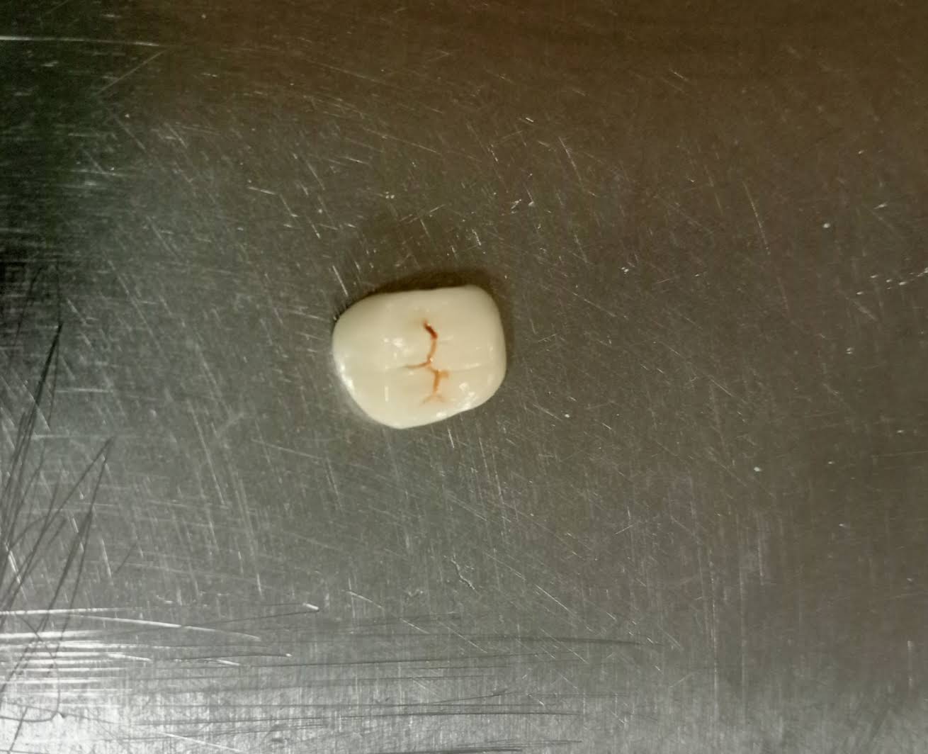 Dental crown ( dental cap)