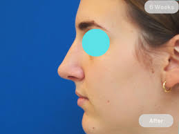 Brisbane Rhinoplasty