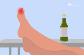See full list on alcoholvolume.com The Link Between Alcohol And Gout Does Drinking Alcohol Affect Gout