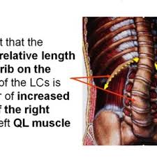 Having pain under your right rib cage very often is a cause for concern because this may be a sign of a serious medical condition. Pdf Idiopathic And Normal Lateral Lumbar Curves Muscle Effects Interpreted By 12th Rib Length Asymmetry With Pathomechanic Implications For Lumbar Idiopathic Scoliosis