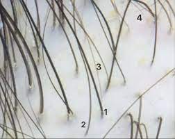 An Up Close Look At Aga Donovan Hair Clinic Androgenetic Alopecia Alopecia Hairstyles Hair Clinic