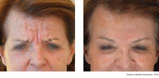 Une combinaison de produits qui crée une seconde peau pour effacer les rides. Les Rides Du Lion A Paris Glabelle Dr Scemama Medecin Esthetique