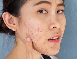 Image result for Papule