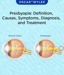 Image result for Presbyopia