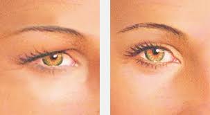 Eyelid Surgery Albany Ny Deluca Plastic Surgery Eyelid Lift Eyebrow Lift Surgery Lower Face Lift Surgery