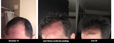We use it for fine lines and wrinkles and we do it for acne scars. 4 5 Months Of Microneedling Progress Tressless