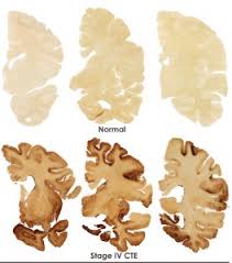 The disease was not found. Marijuana Heals Brain After Head Trauma You Listening Nfl
