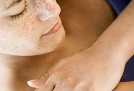 Hives can be round, or they can form rings or large patches that can occur anywhere on the body, such as the trunk, arms and legs. Are Hives Urticaria Contagious