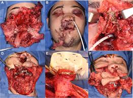 Shotgun wounds distance from the victim is important factor in determining extent of tissue damage there are multiple pellets of varying sizes and numbers. Functional Anatomic Computer Engineered Surgery Protocol For The Management Of Self Inflicted Gunshot Wounds To The Maxillofacial Skeleton Sciencedirect