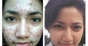 Flek atau noda hitam di wajah bisa disebabkan oleh berbagai hal, misalnya bekas jerawat, salah kosmetik, hormon, atau paparan sinar matahari secara terus menerus. Cara Menghilangkan Bekas Jerawat Merah Susah Hilang