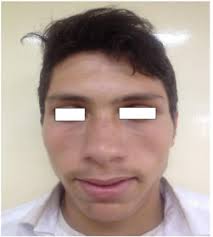 Lujan–Fryns Syndrome (LFS): A Unique Combination of Hypernasality,  Marfanoid Body Habitus, and Neuropsychiatric Issues, Presenting as  Acute-Onset Dysphagia