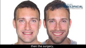 Dr. Sam Daher Class III, Crossbite Aligner Case Review With AcceleDent