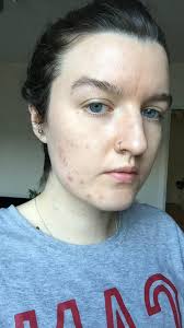 One for me (wrinkles) and one for my daughter (acne) at the end of 30 treatments i see better i had an extremely severe case of rosacea and i started using the neutrogena light therapy acne mask along with the acne face treatment kit. Led Light For Acne Does It Work Results Side Effects
