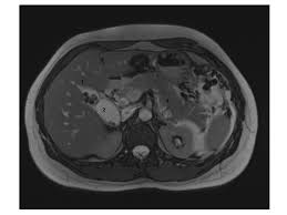 Maybe you would like to learn more about one of these? Cureus Y Shaped Vesica Fellea Duplex Gallbladder Causing Acute Biliary Pancreatitis