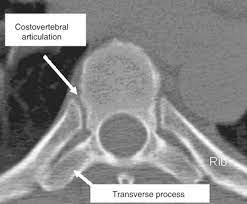 Although the fracture is not associated with spinal cord damage and neurological deficits, the extreme force of the injury can cause visceral injuries and internal hemorrhage. Trauma Surgery Thoracic And Thoracolumbar Junction Neupsy Key